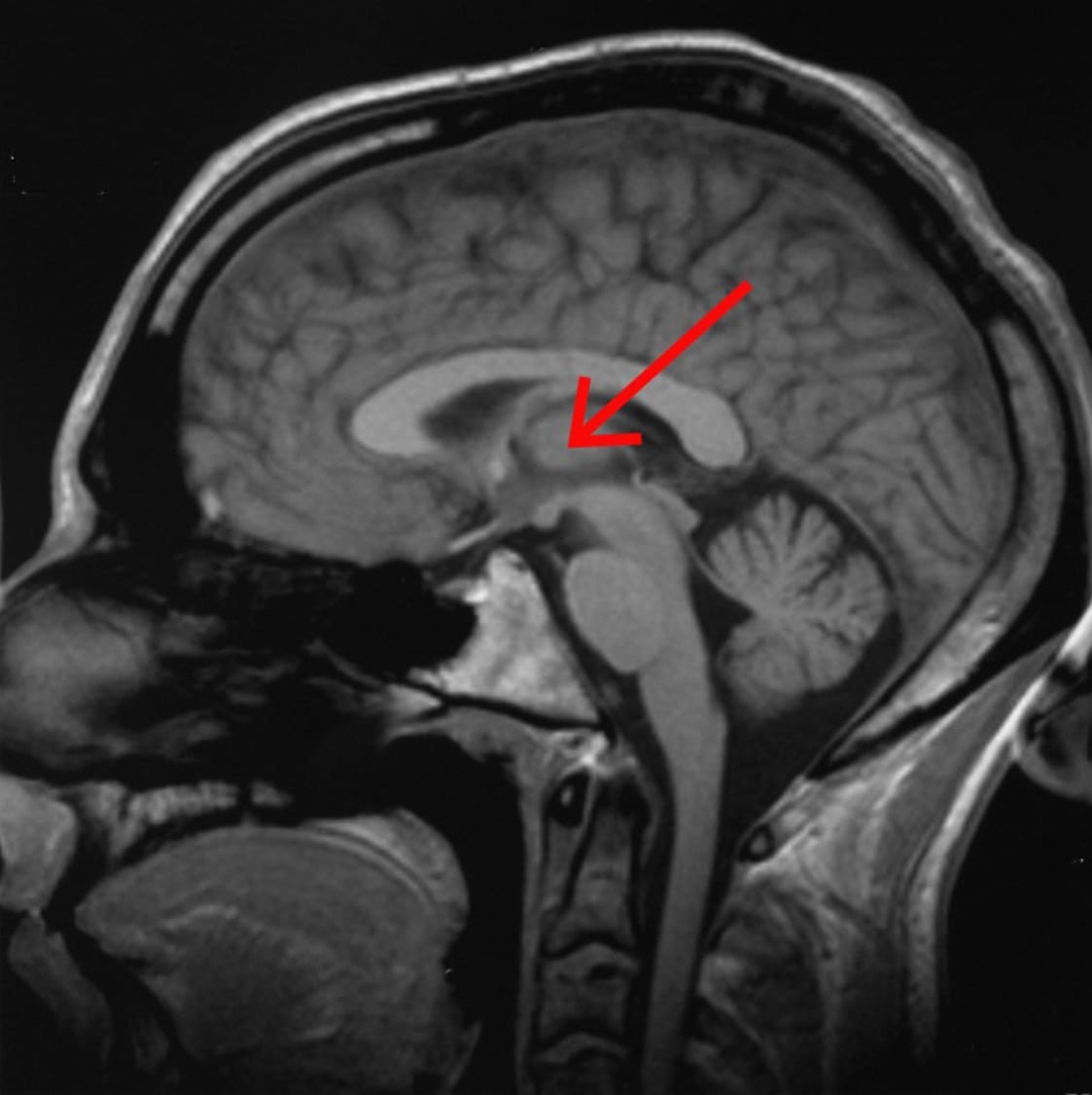 CT Scan of a brain, with a red arrow pointing out the thalamus deep in the center.